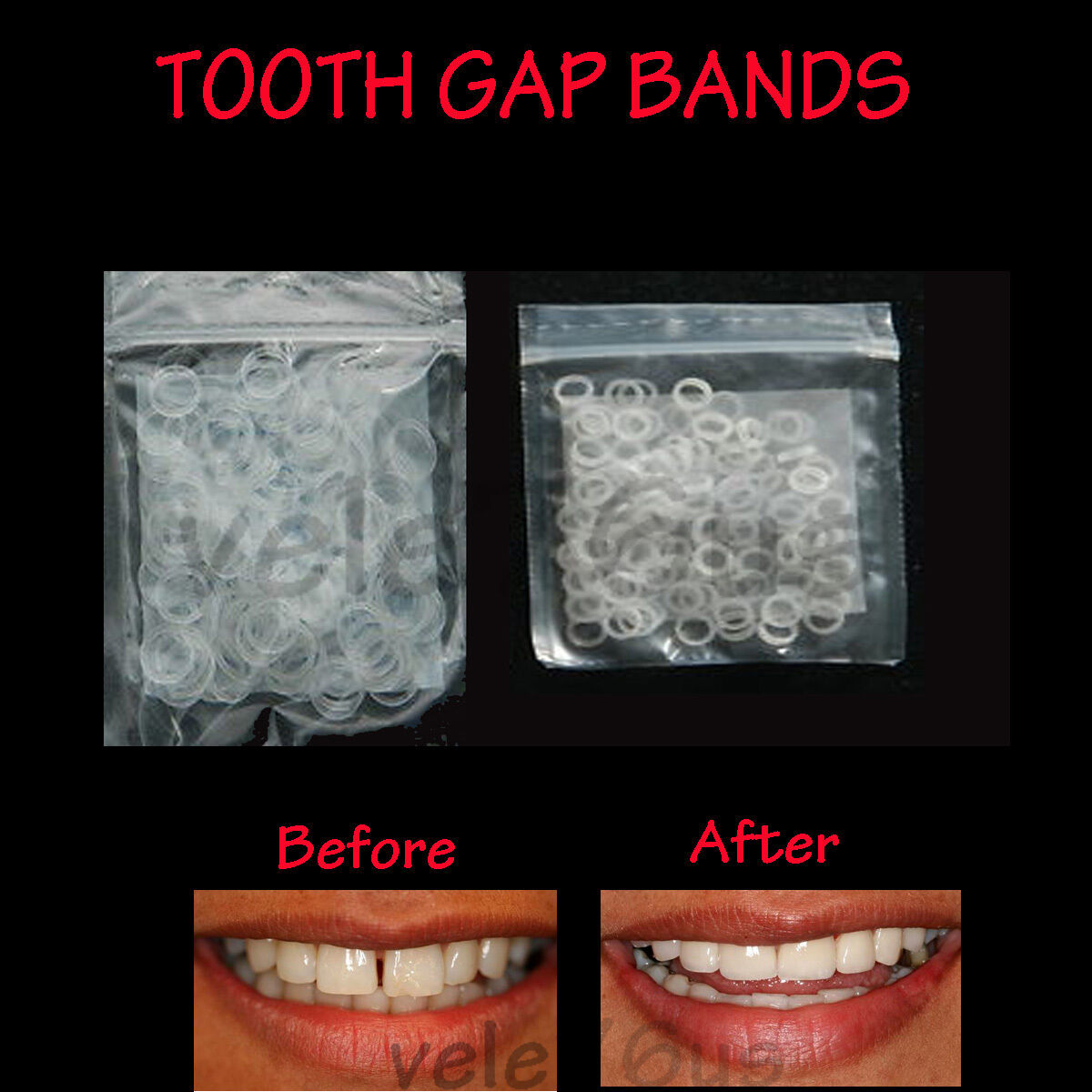 Tooth Gap Bands -- 3.5 Oz Orthodontic Bands -3/16" - Instructions Included